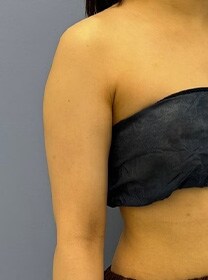 二の腕の脂肪吸引　症例写真　ビフォー