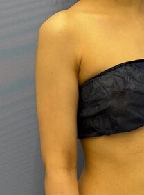 二の腕の脂肪吸引　症例写真　アフター