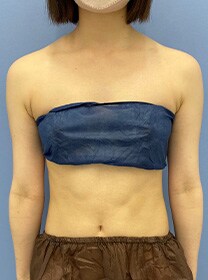 二の腕の脂肪吸引　症例写真　ビフォー