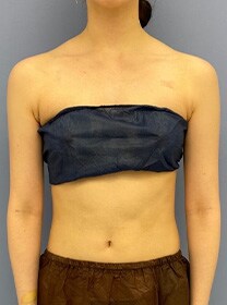 二の腕の脂肪吸引　症例写真　アフター