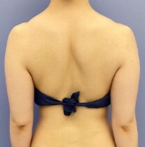 背中の脂肪吸引　症例写真　ビフォー