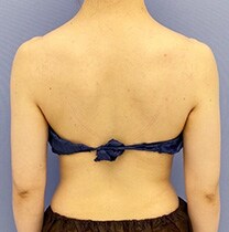 背中の脂肪吸引　症例写真　アフター