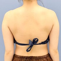 背中の脂肪吸引　症例写真　ビフォー