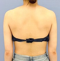 背中の脂肪吸引　症例写真　アフター