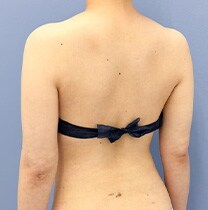 背中の脂肪吸引　症例写真　アフター
