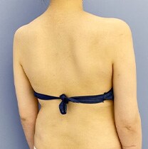 背中の脂肪吸引　症例写真　アフター