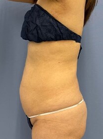 お腹の脂肪吸引　症例写真　ビフォー