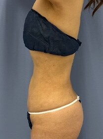 お腹の脂肪吸引　症例写真　アフター