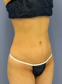 お腹の脂肪吸引　症例写真　アフター