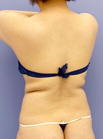 お腹の脂肪吸引　症例写真　ビフォー