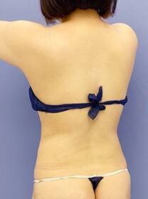 お腹の脂肪吸引　症例写真　アフター