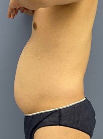 お腹の脂肪吸引　症例写真　ビフォー