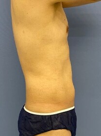 お腹の脂肪吸引　症例写真　ビフォー