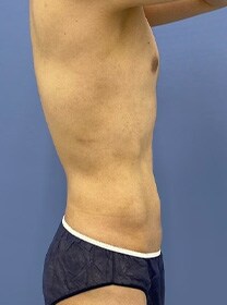 お腹の脂肪吸引　症例写真　アフター