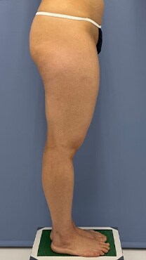 下半身の脂肪吸引　症例写真　ビフォー