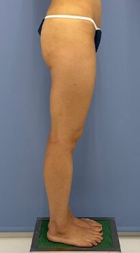 下半身の脂肪吸引　症例写真　アフター