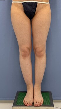 下半身の脂肪吸引　症例写真　ビフォー