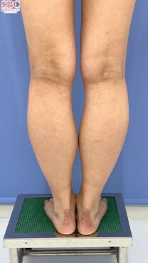 下半身の脂肪吸引　症例写真　ビフォー