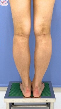 下半身の脂肪吸引　症例写真　アフター