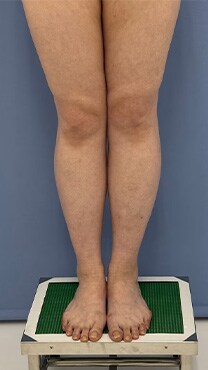 下半身の脂肪吸引　症例写真　ビフォー