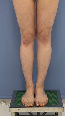 下半身の脂肪吸引　症例写真　アフター