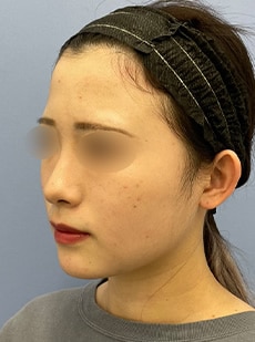 1Week After