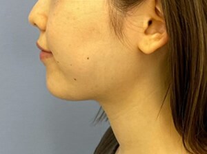 1Week After