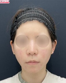 1Week After