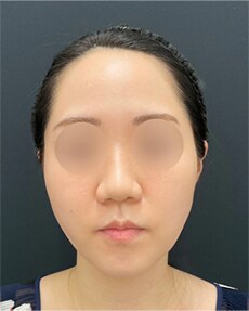 1Week After
