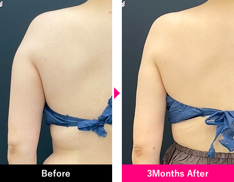 二の腕＋肩の症例写真