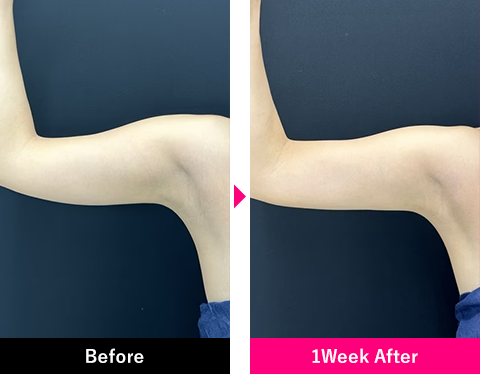 二の腕＋肩の症例写真