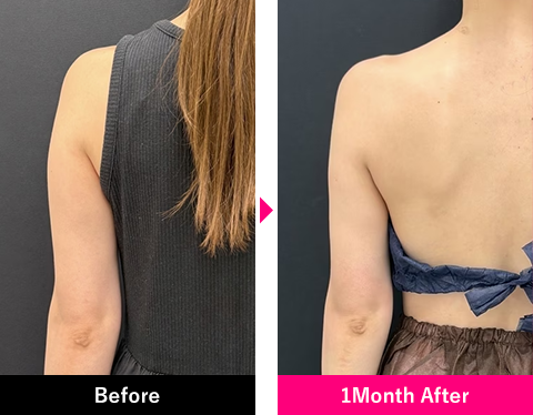 二の腕＋肩甲骨横＋肩の症例写真