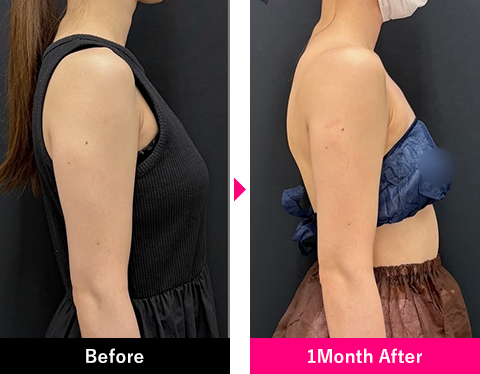 二の腕＋肩甲骨横＋肩の症例写真