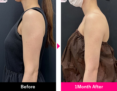 >二の腕＋肩甲骨横＋肩の症例写真