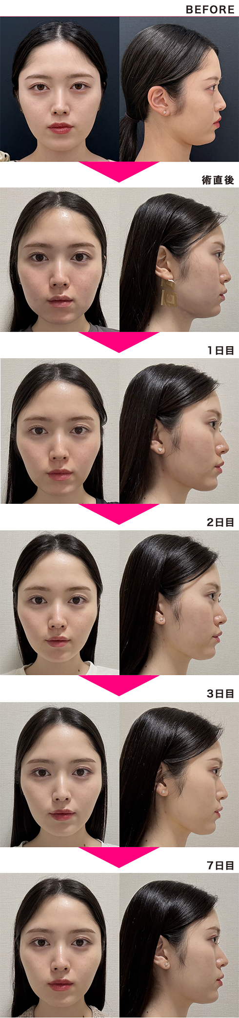小顔用脂肪吸引注射の経過