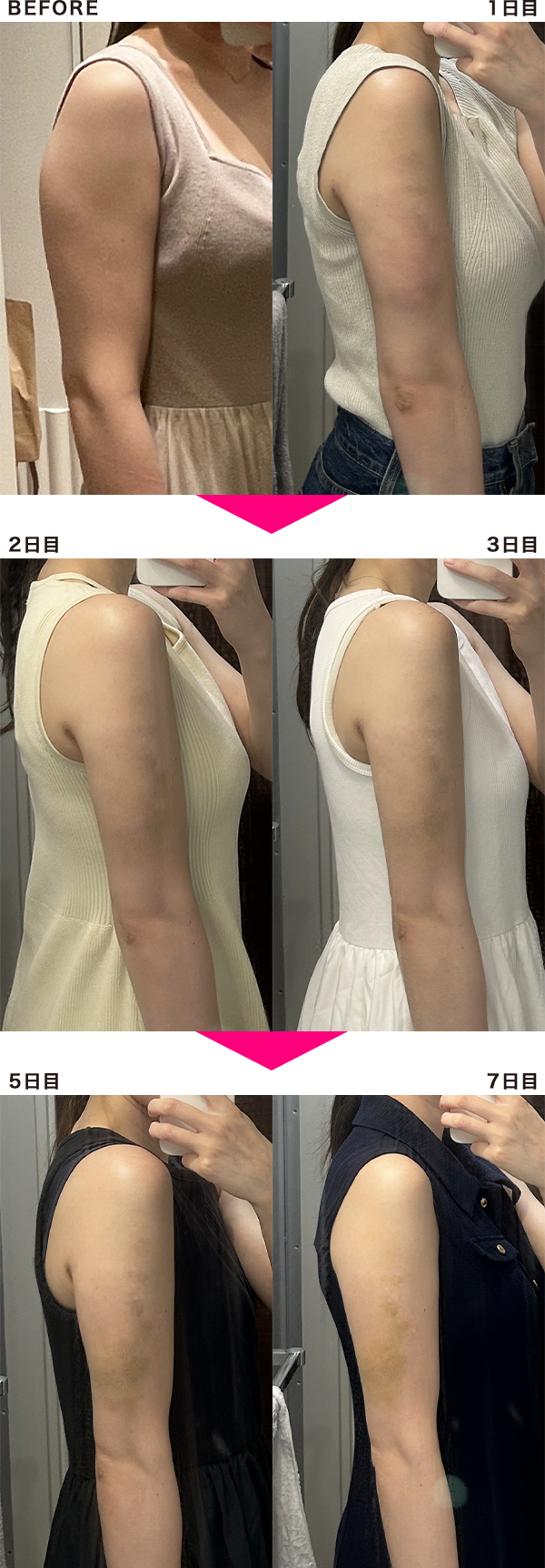 脂肪吸引注射 BODYの経過