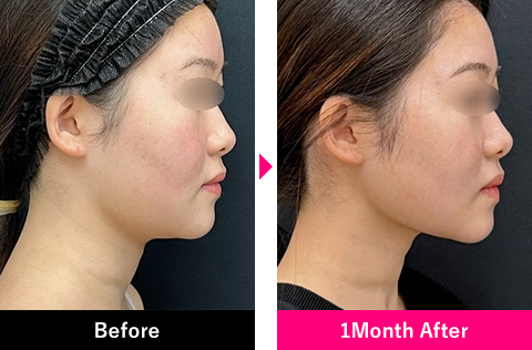 小顔用脂肪吸引注射の症例写真1