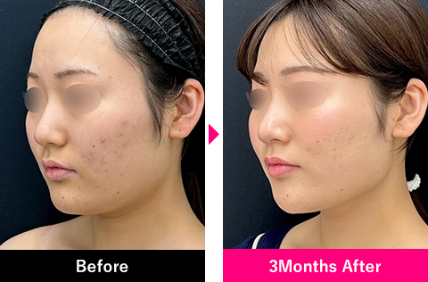 小顔用脂肪吸引注射の症例写真２