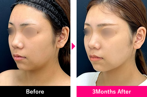 小顔用脂肪吸引注射の症例写真3