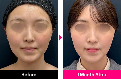 小顔用脂肪吸引注射の症例写真4