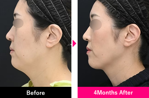 脂肪吸引注射の症例写真5