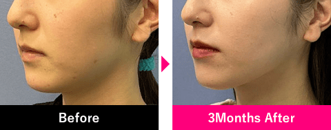 小顔用脂肪吸引注射頬2エリア、顎下2エリア×VOVリフト6本の症例写真
