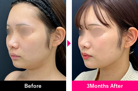 小顔用脂肪吸引注射＋糸リフトの症例写真