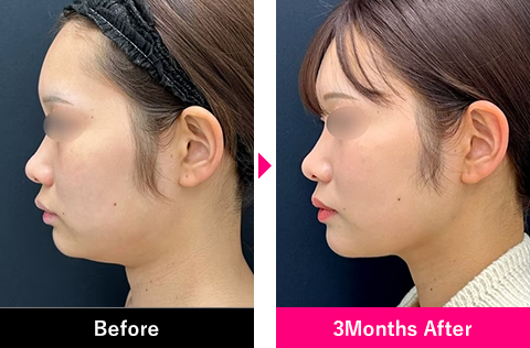 小顔用脂肪吸引注射＋糸リフトの症例写真