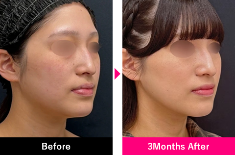 小顔用脂肪吸引注射＋糸リフトの症例写真