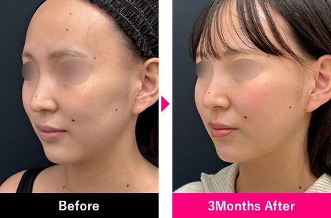 小顔用脂肪吸引注射＋糸リフトの症例写真