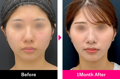 小顔用脂肪吸引注射＋糸リフトの症例写真