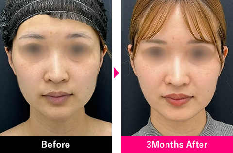 小顔用脂肪吸引注射＋糸リフトの症例写真