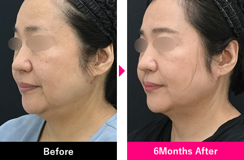 脂肪吸引注射＋エンブレイスRFの症例写真