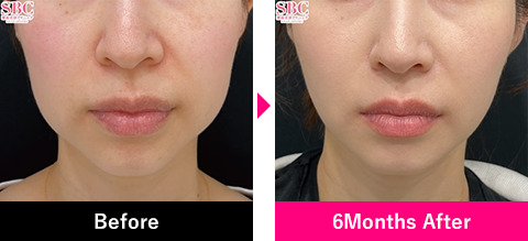 脂肪吸引注射＋糸リフトの症例写真